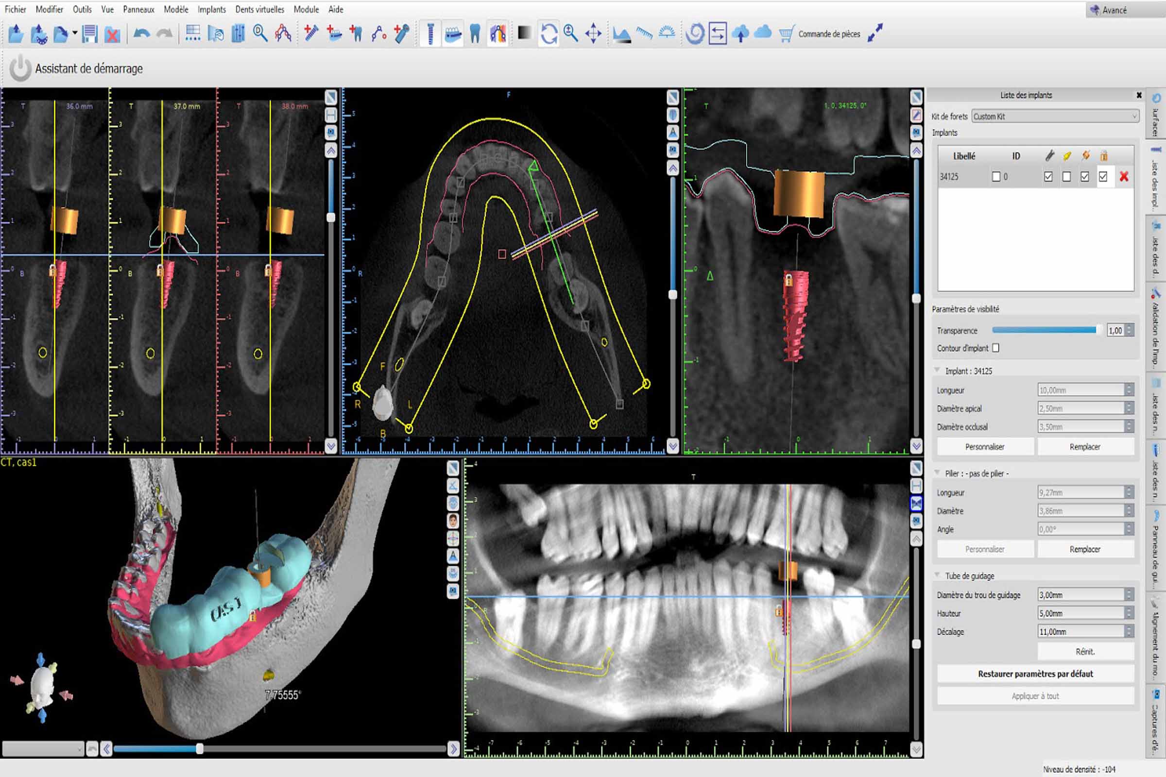 Eliminate the guesswork in dental implant surgery planning