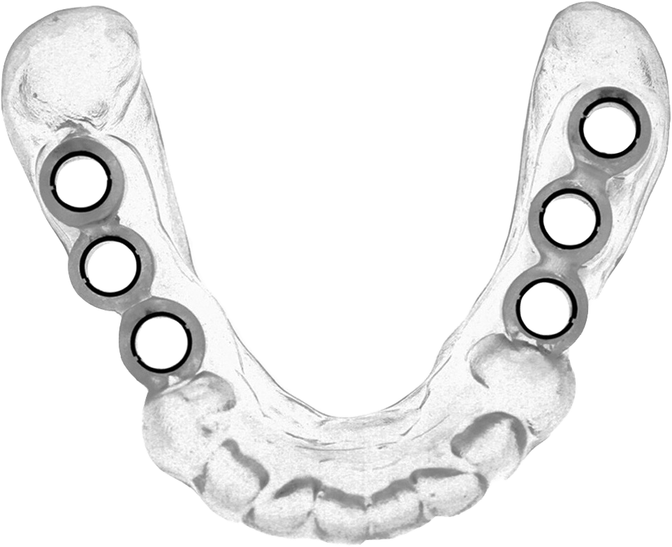 Implant Surgery Guide