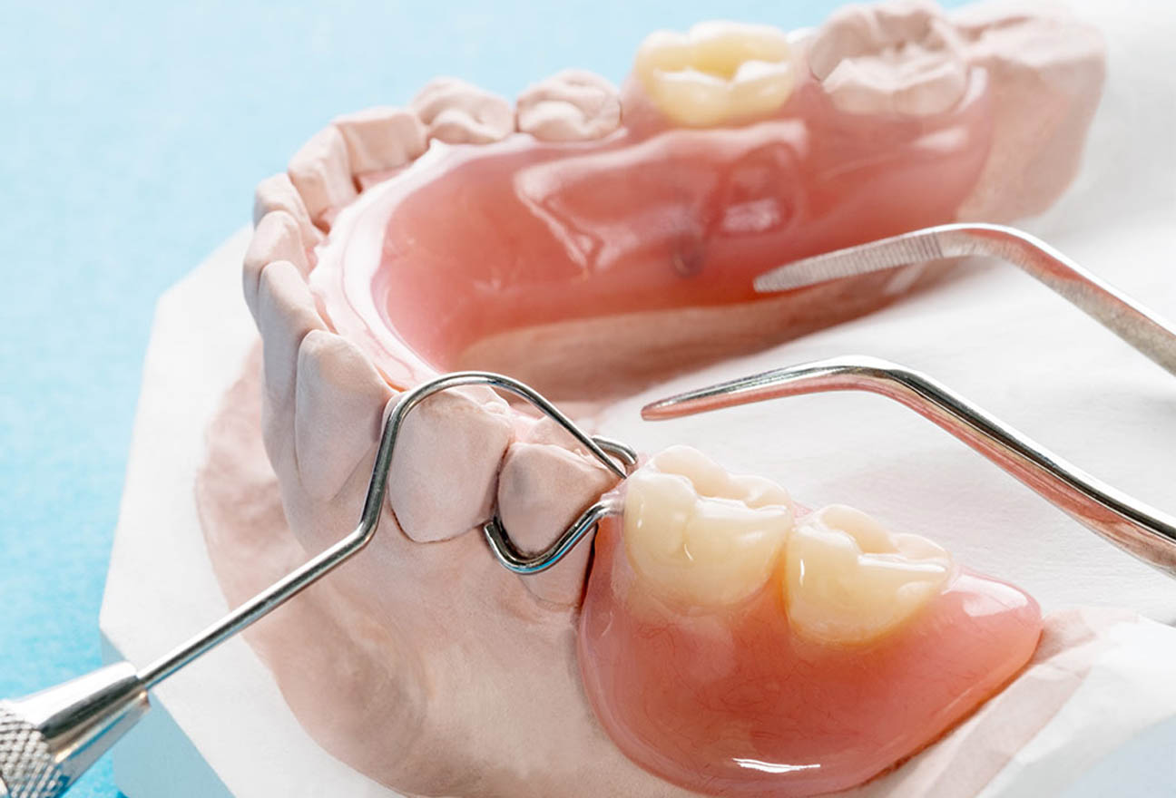 partial denture process from start to finish